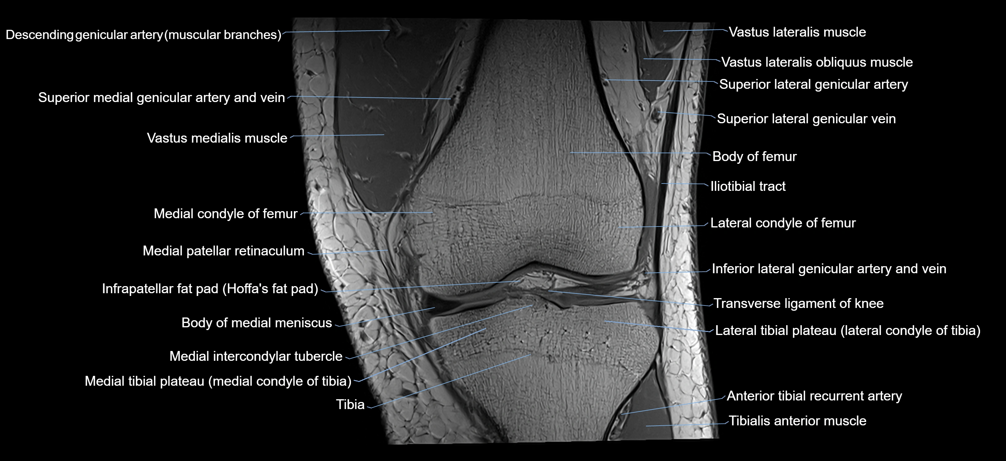 MRI knee coronal cross sectional anatomy labelled 3T radiology  image-04001-00016.webp